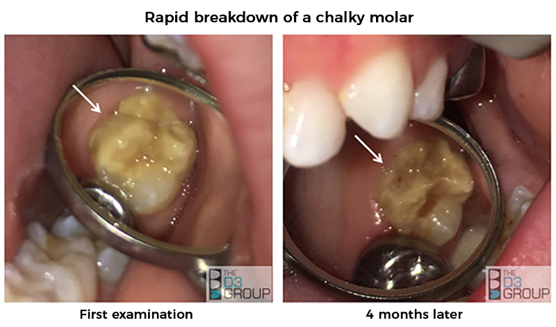 Rapid Breakdown of Chalky Molar