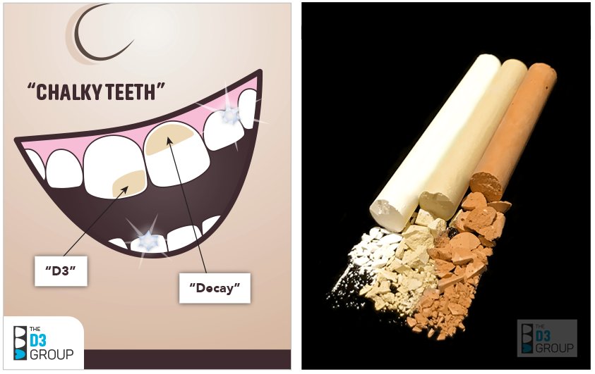 Pic1: Chalky Teeth image showing decay and D3 difference, Pic 2: crumbly chalk pic