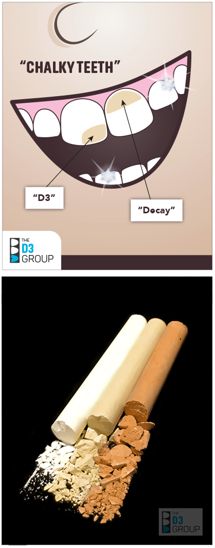 Pic1: Chalky Teeth image showing decay and D3 difference, Pic 2: crumbly chalk pic